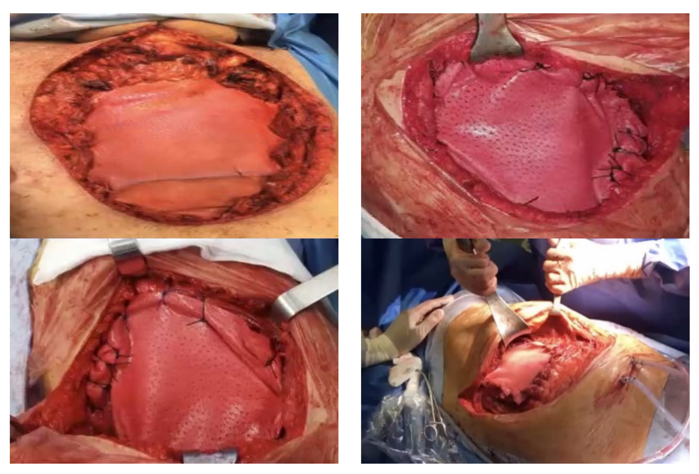 Appearance of chest wall before operation.