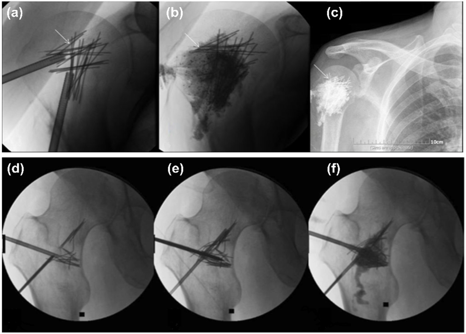 ランキングや新製品 Percutaneous-Reinforced Osteoplasty: Emerging of Review A 健康・医学