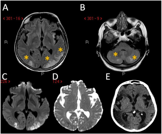 Mechanisms and Neuroimaging Patterns of Hypereosinophilia Mechanisms and Neuroimaging Patterns of Hypereosinophilia