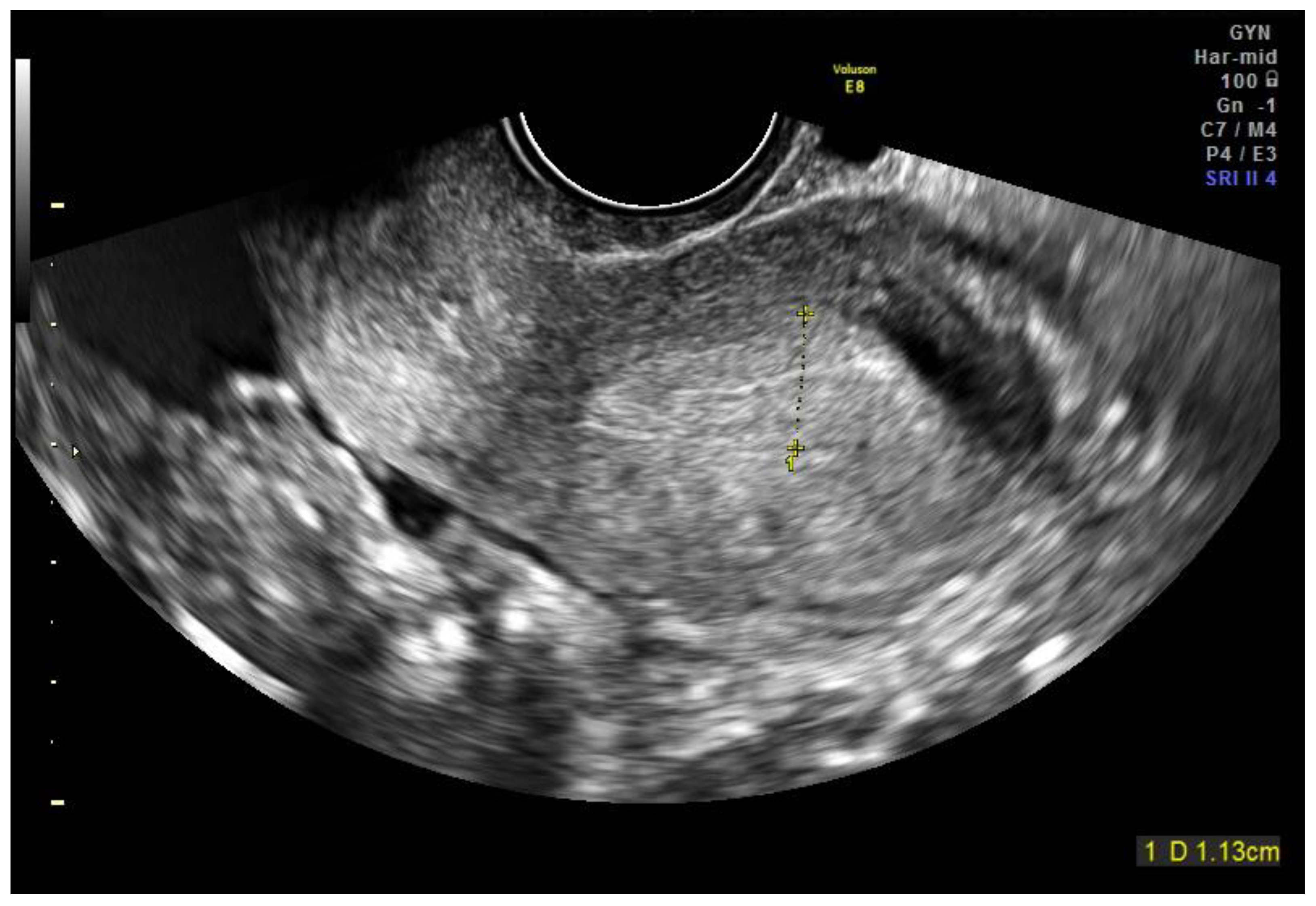 Terconazole Pregnancy - mfwywed