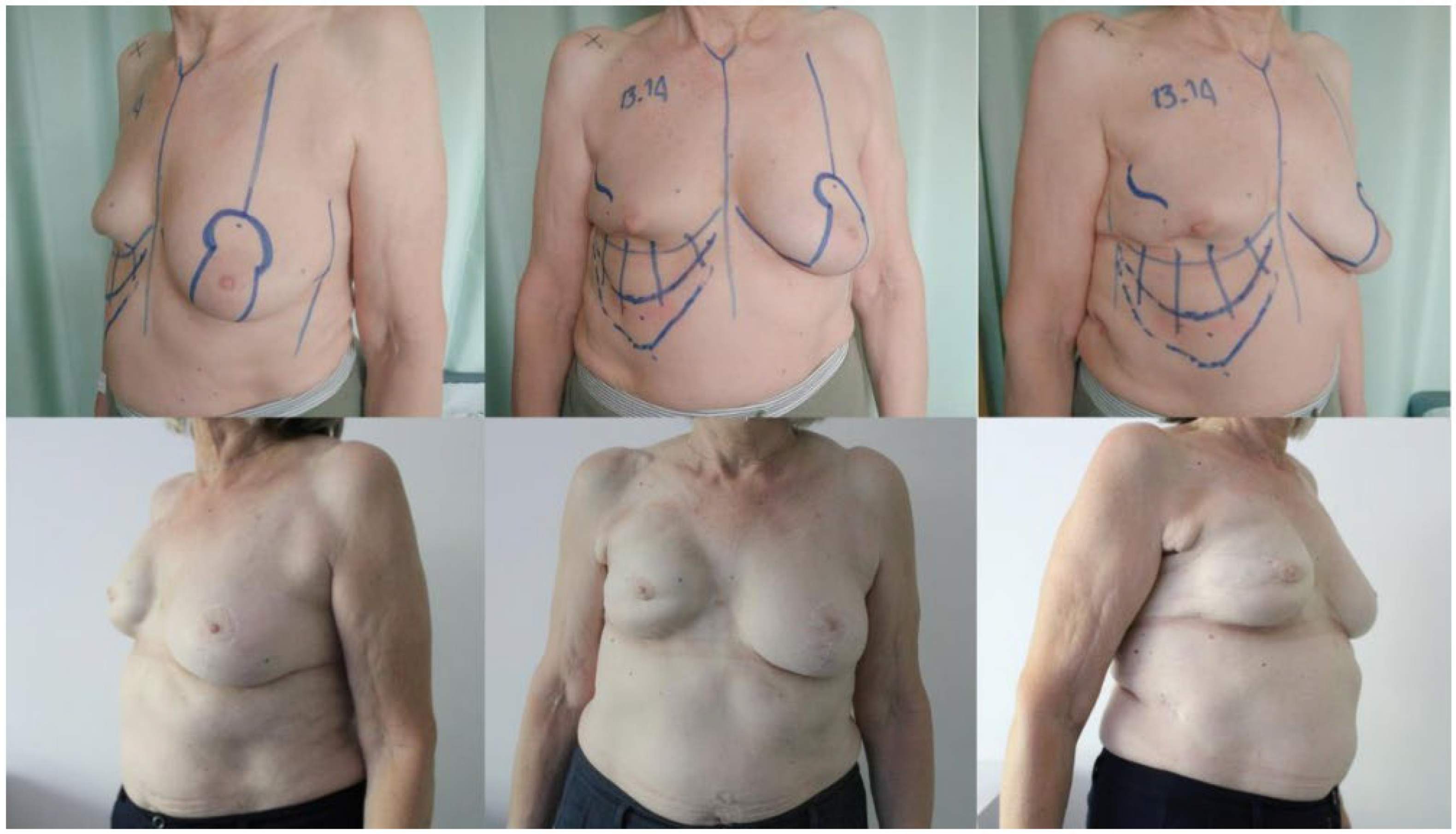 Nipple–Areolar Reconstruction