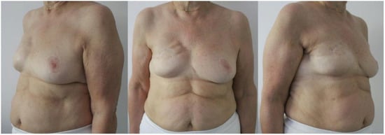 Breast Augmentation Sub muscular IMF Incision 