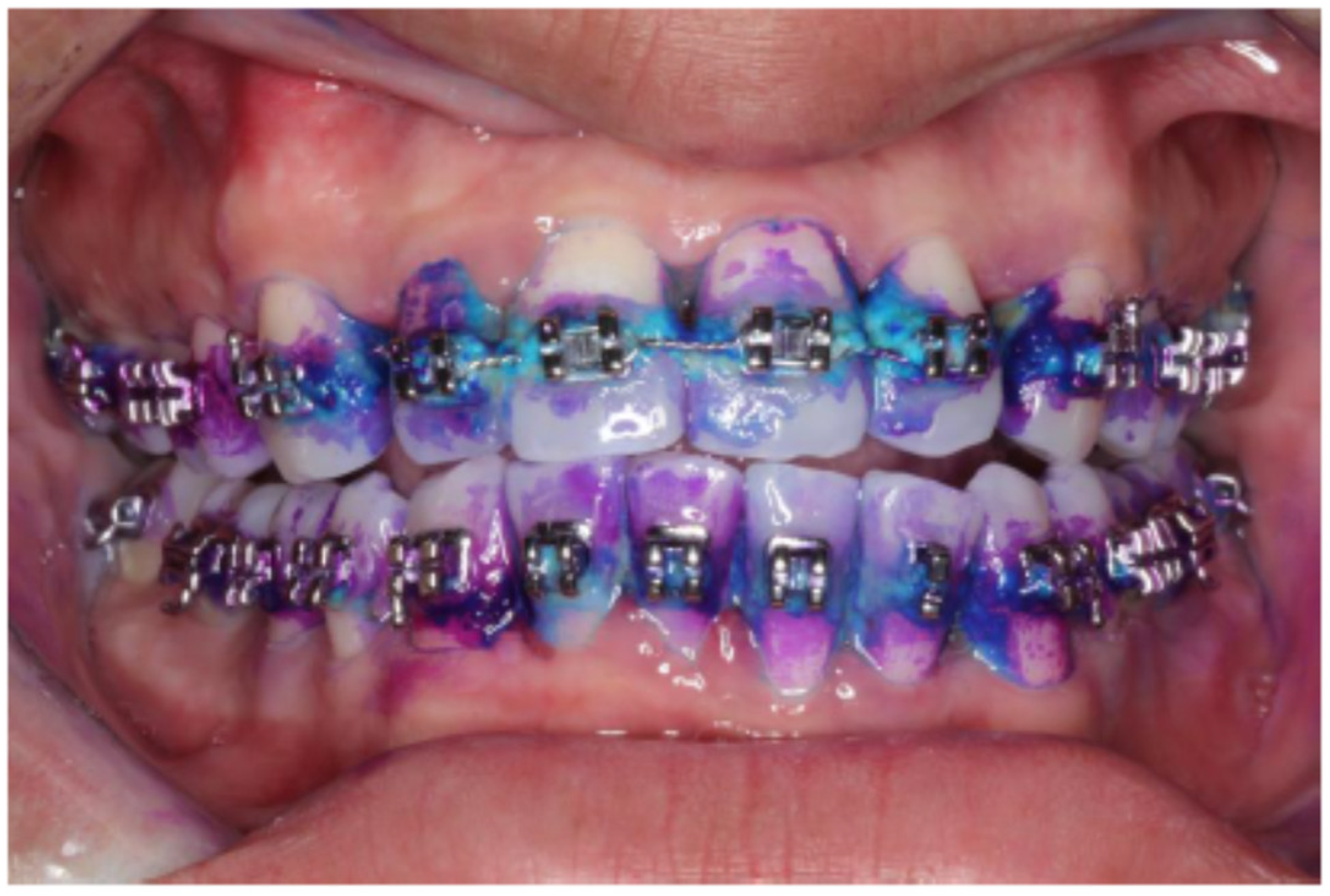 JCM Free Full Text Fixed Orthodontic Treatment Increases