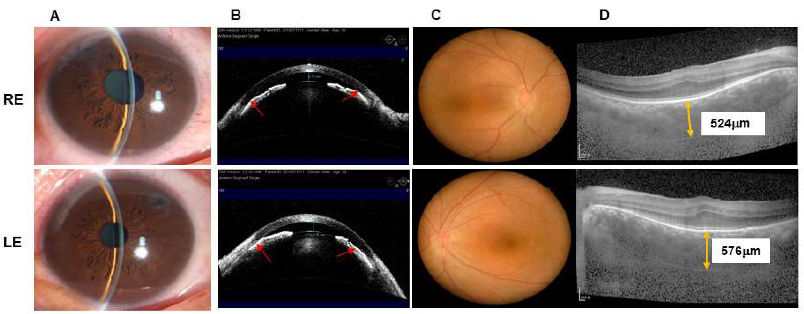 JCM | Free Full-Text | Effect of Combined Surgery in Patients with Complex  Nanophthalmos