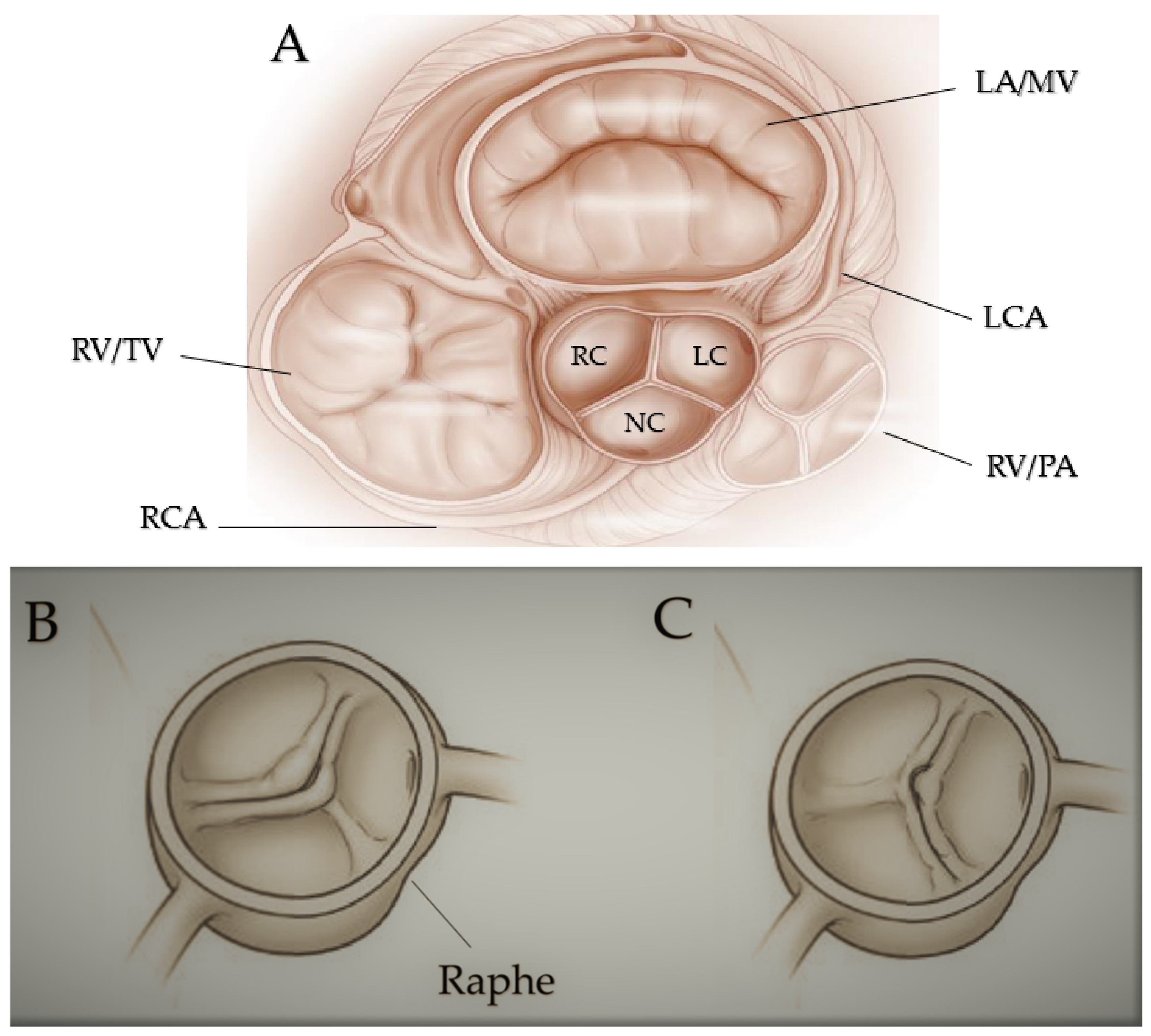 JCM | Free Full-Text | Patients with Bicuspid Aortopathy and Aortic  Dilatation