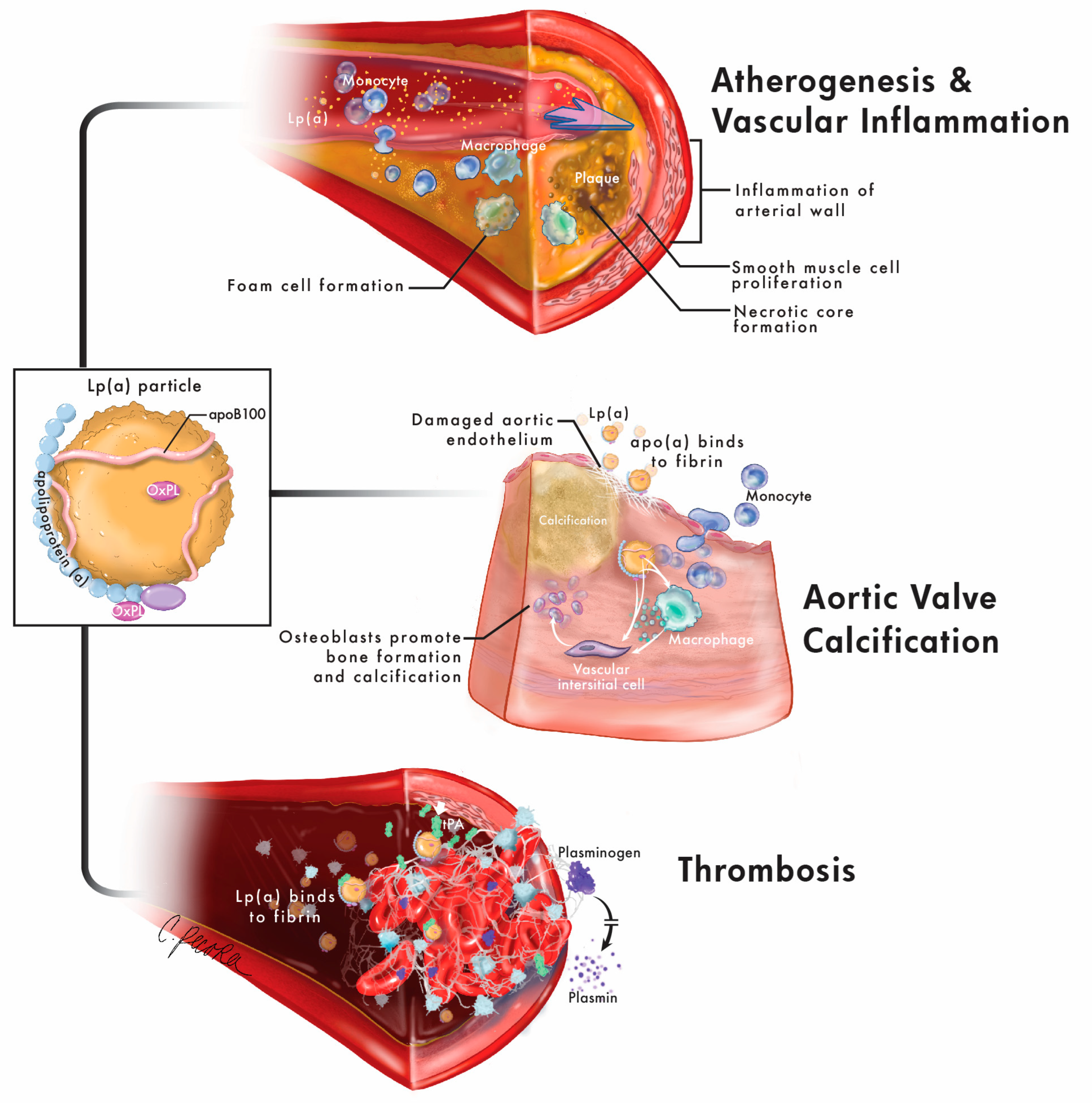 Lipoprotein(a): A Genetically Determined, Causal, and Prevalent