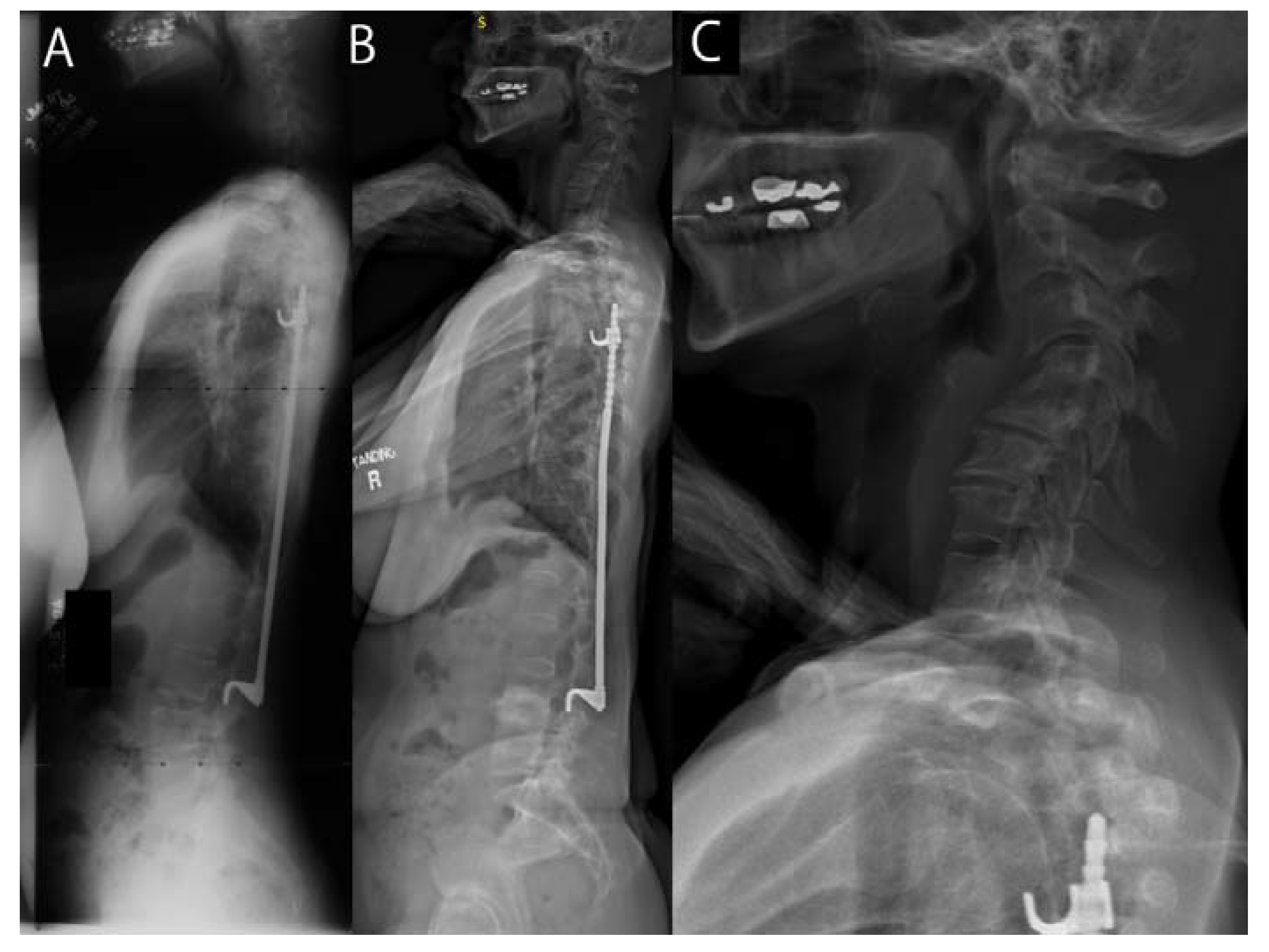 JCM Free FullText At Mean 30Year FollowUp, Cervical Spine