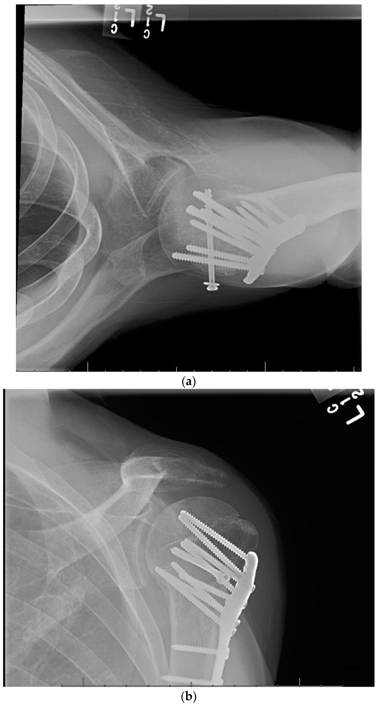Biomechanical comparisons of hook plate and screw fixations in split-type  greater tuberosity fractures of the humerus