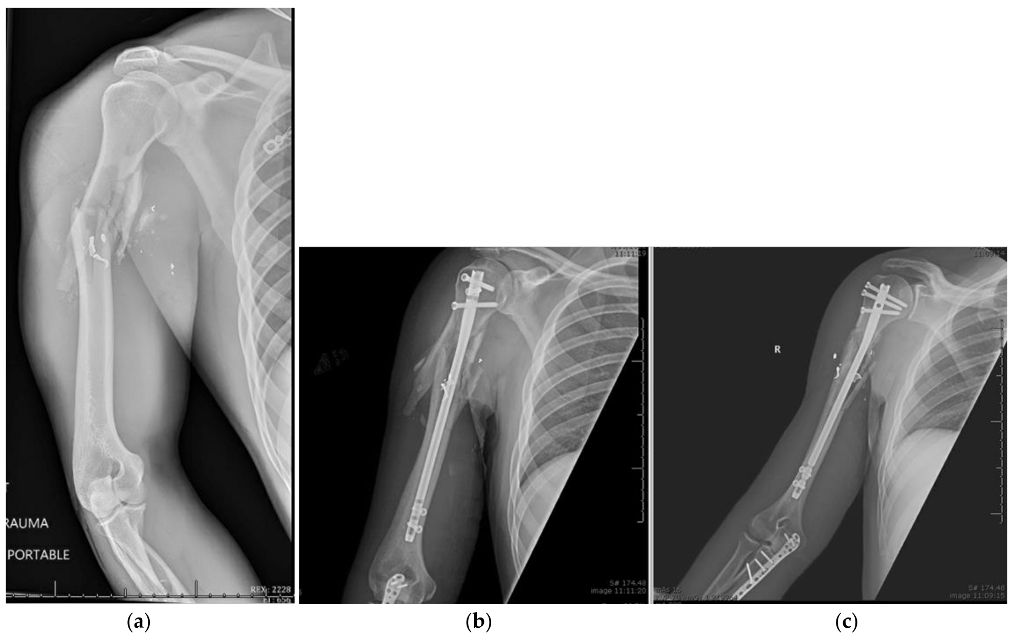 proximal humerus fracture presentation