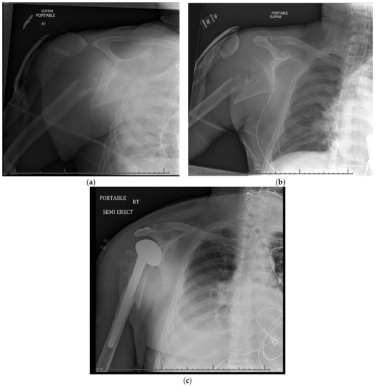 Management of Proximal Humerus Fractures in Adults—A Scoping Review