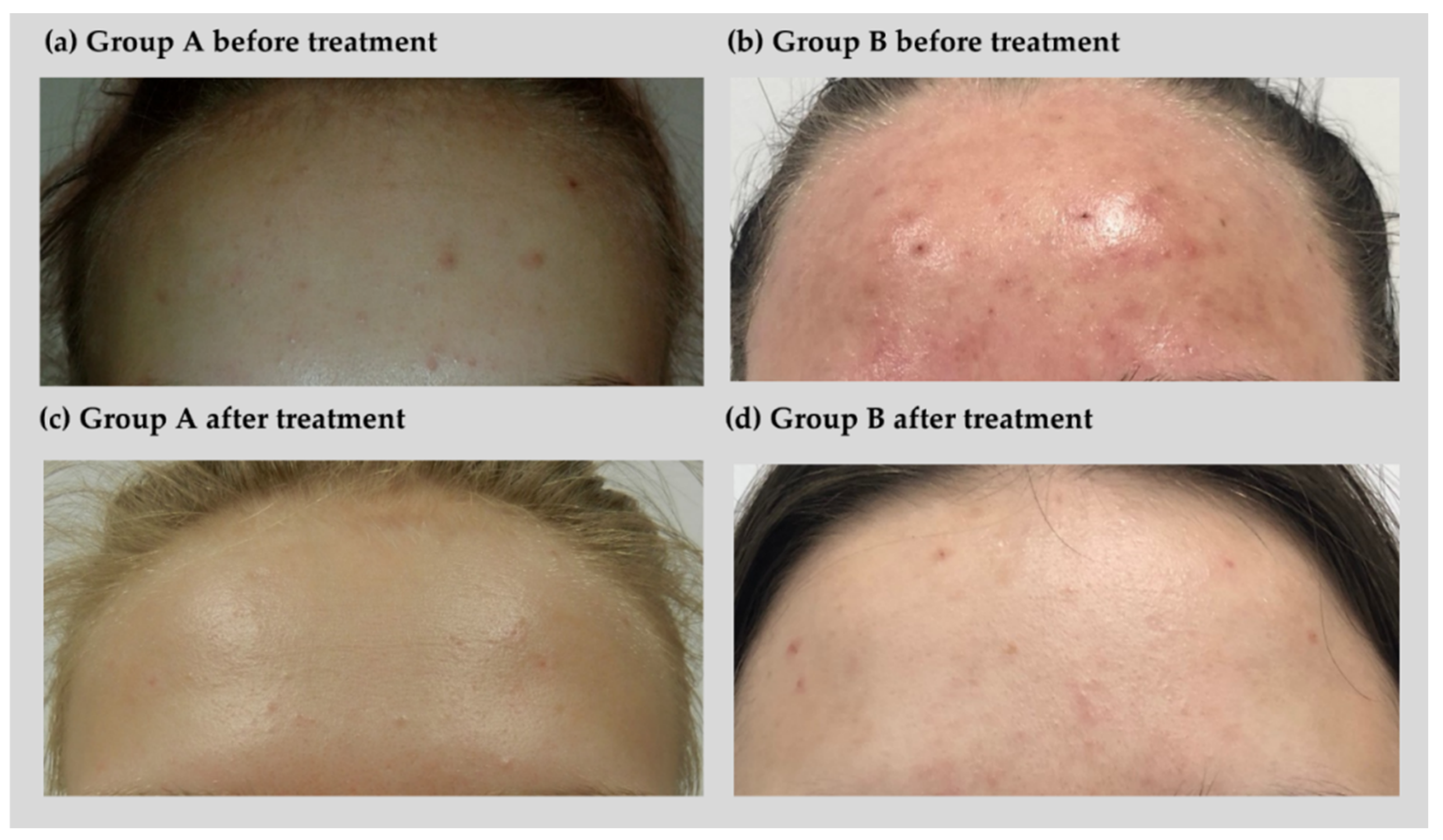 Kangen water acne treatment shop