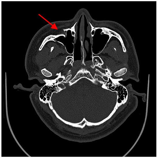 Maxillary Sinus Fracture