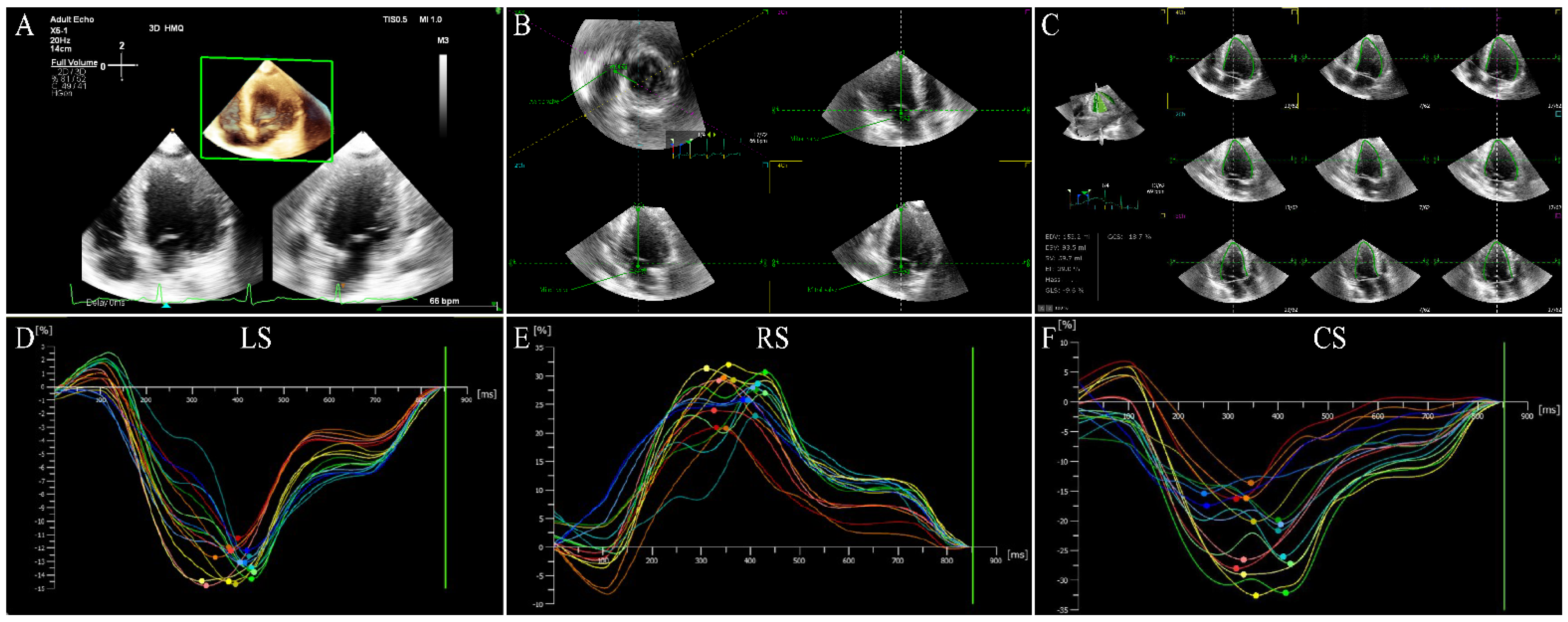 Comprehensive Left Ventricular Mechanics Analysis by Speckle Tracking  Echocardiography in COVID-19