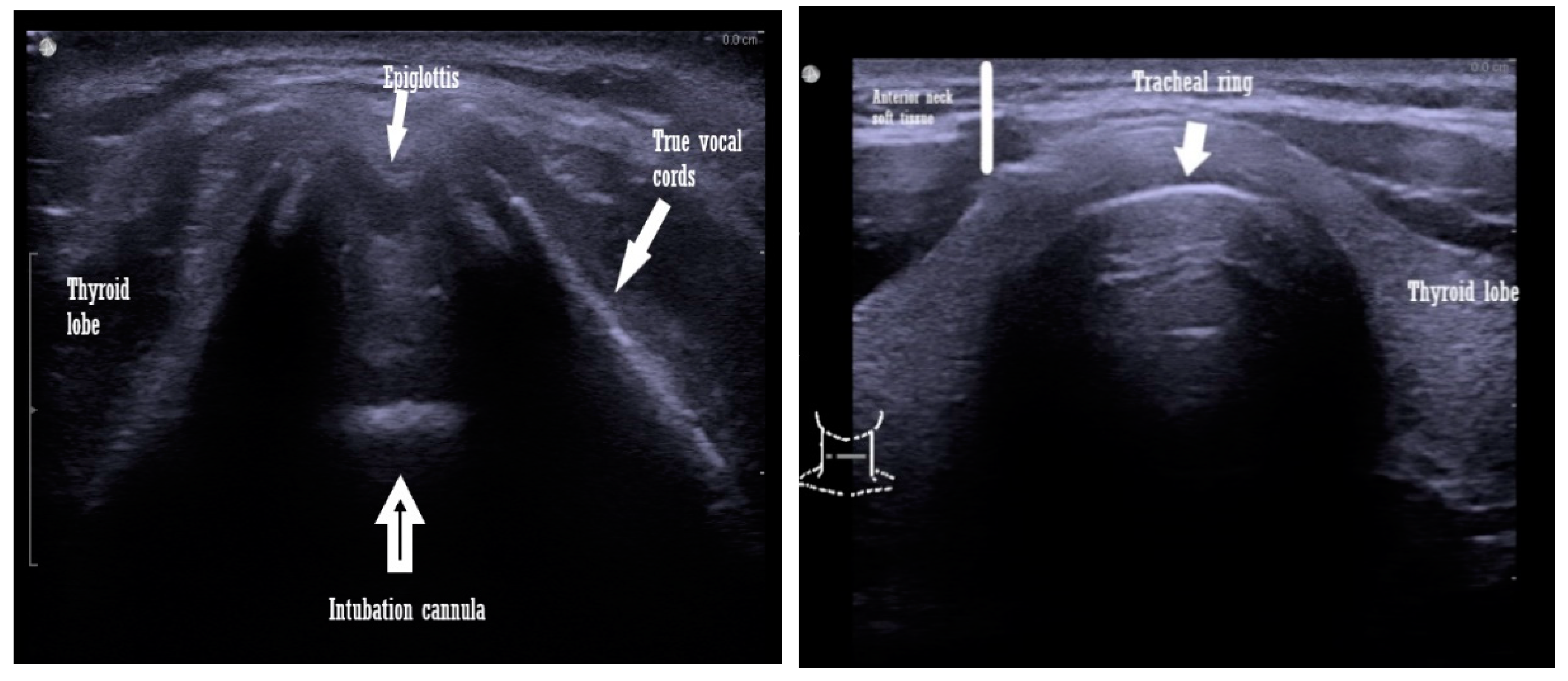 Anterior Larynx Difficult Intubation