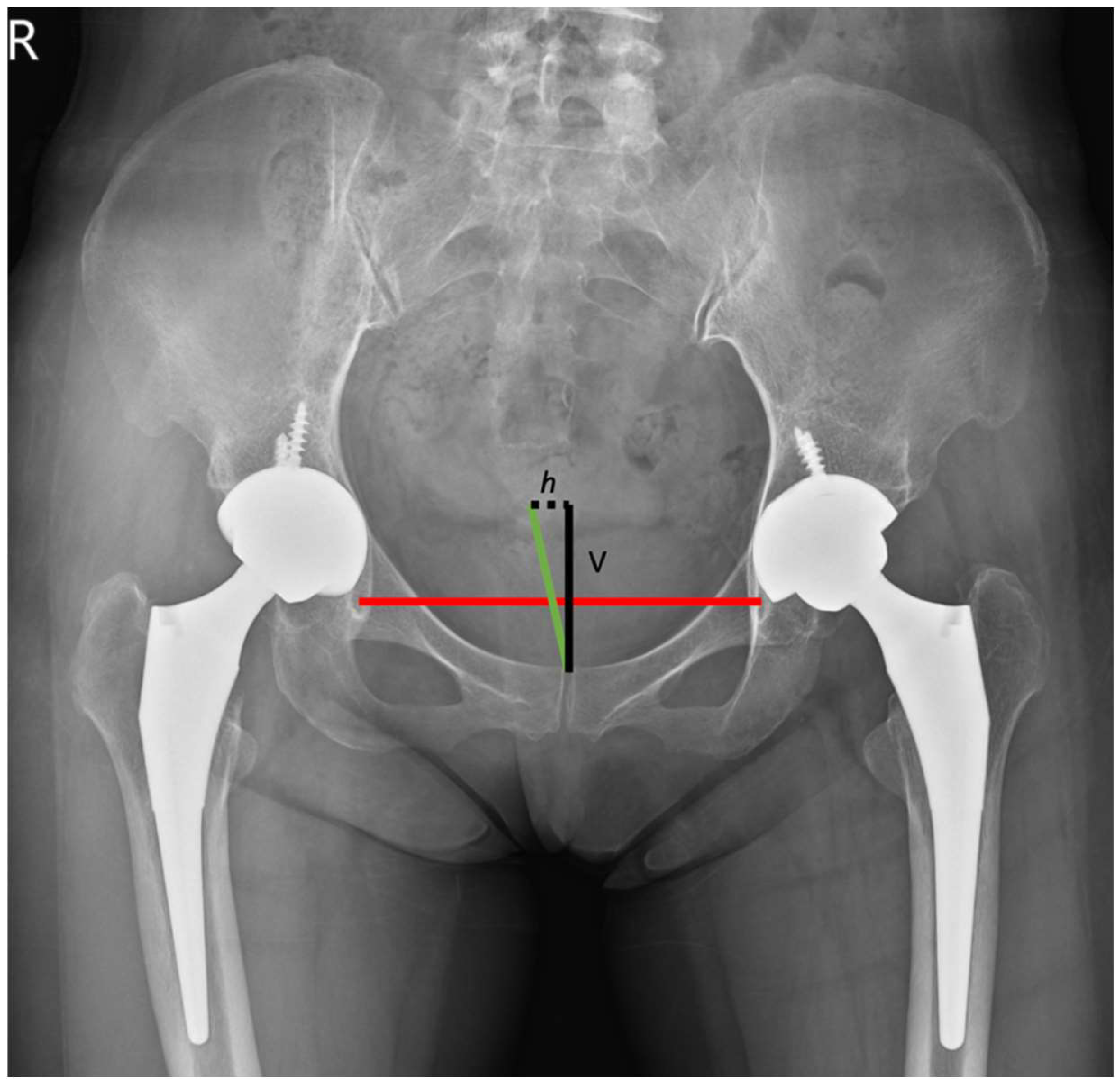 JCM Free FullText Degree of Pelvic Rotation in the Coronal Plane