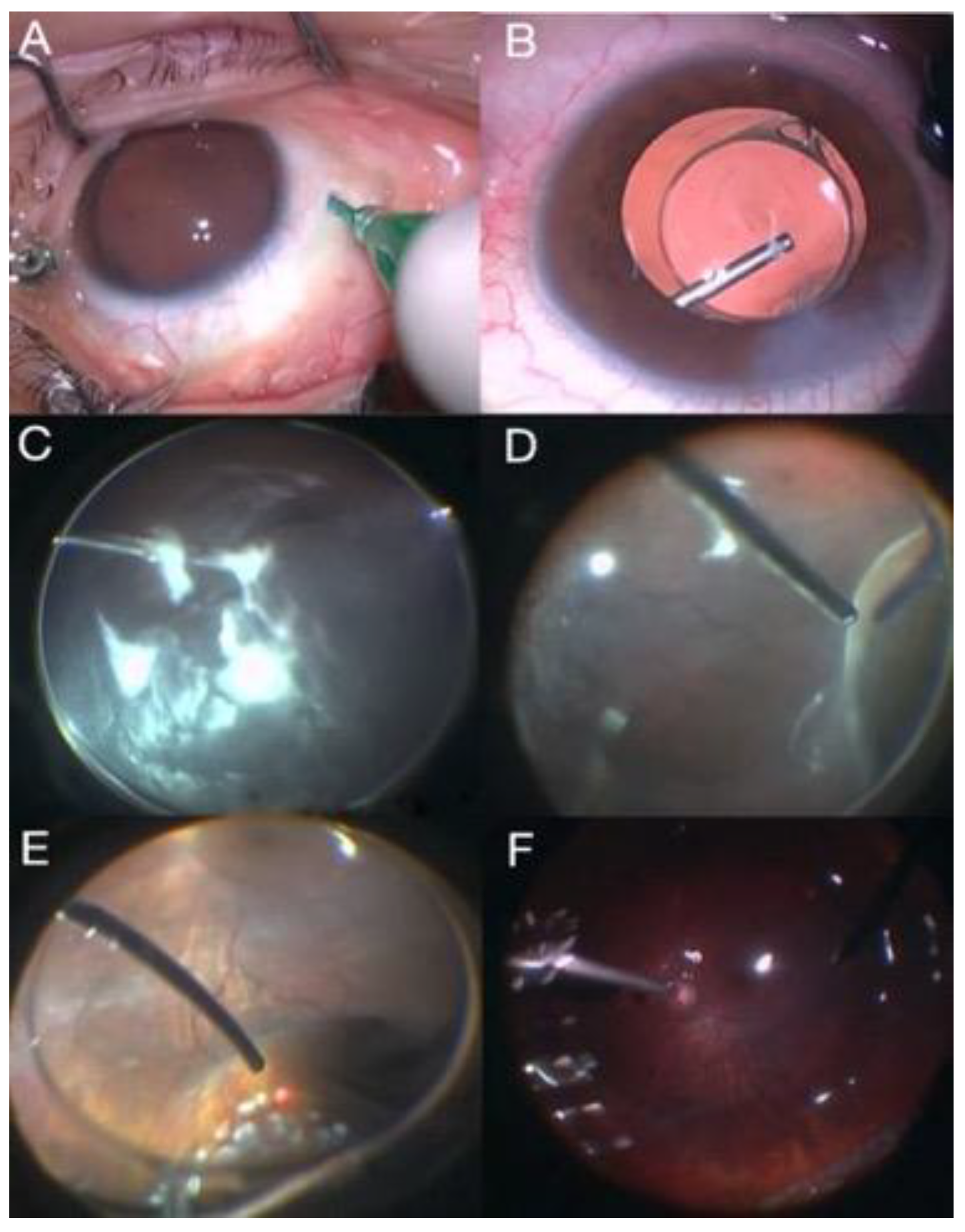 Vitreoretinal Eye Surgery Broward & Miami-Dade, FL | Aran