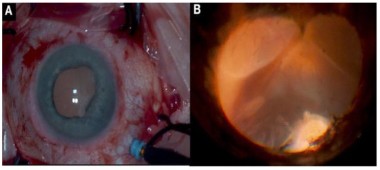 Vitreoretinal Surgical Techniques, Second Edition