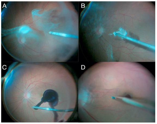 Vitrectomy Surgery Strategies ＆Tactics Opening and Vitrectomy Basics | 3.1 | Vitreoretinal Surgery