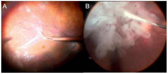 Vitreoretinal Surgical Techniques, Second Edition