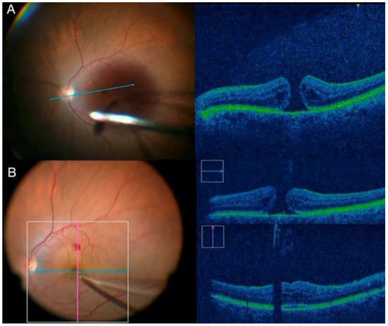健康・医学 Vitreoretinal Surgery Strategies Tactics 健康・医学 Vitreoretinal Surgery Strategies Tactics