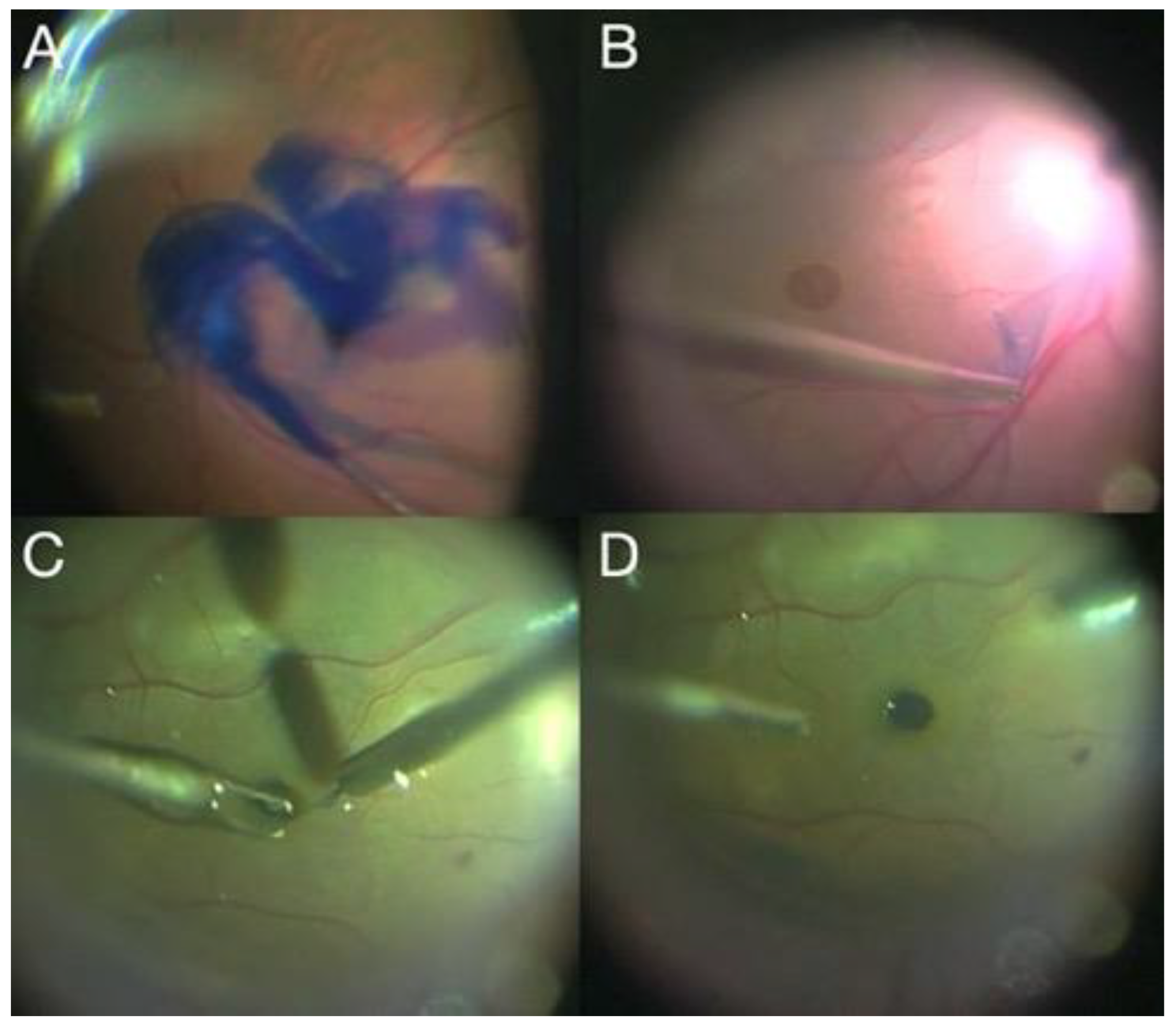 Advances in Vitreoretinal Surgery