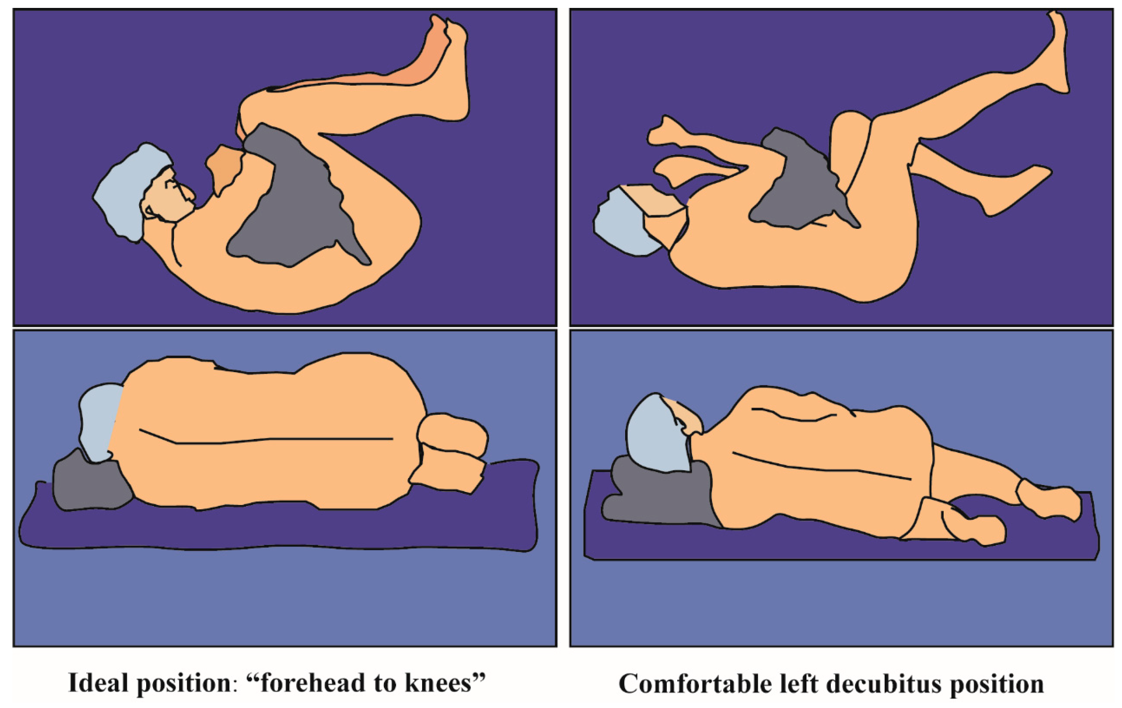 JCM | Free Full-Text | Real Time Ultrasound-Guided Thoracic Epidural  Catheterization with Patients in the Lateral Decubitus Position without  Flexion of Knees and Neck: A Preliminary Investigation