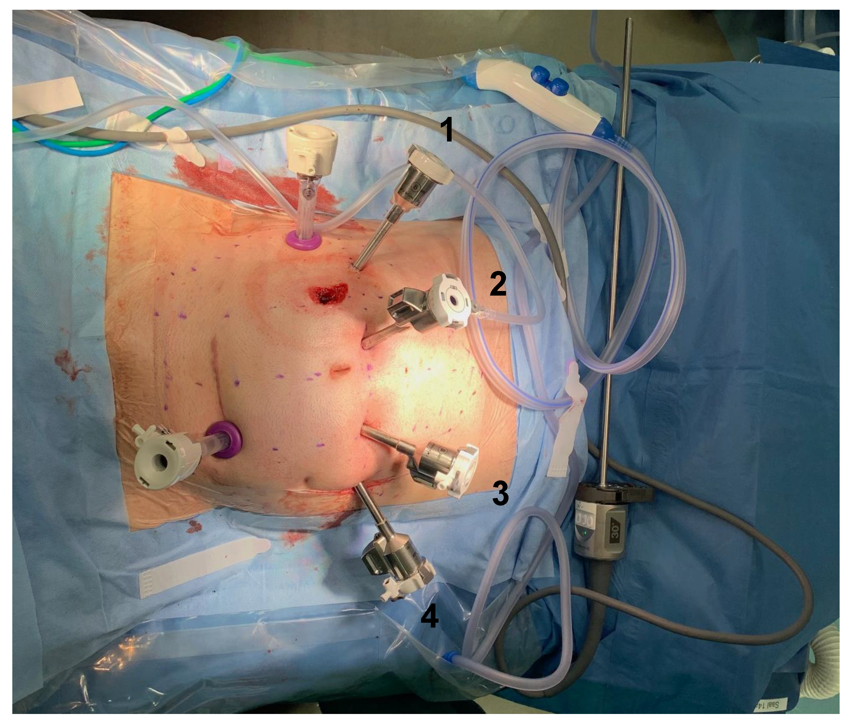 JCM Free Full-Text Robotic-Assisted versus Laparoscopic Proctectomy with Ileal Pouch-Anal Anastomosis for Ulcerative Colitis An Analysis of Clinical and Financial Outcomes from a Tertiary Referral Center
