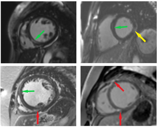 Echocardiography and cardiovascular magnetic resonance based evaluation of myocardial  strain and relationship with late gadolinium enhancement, Journal of  Cardiovascular Magnetic Resonance