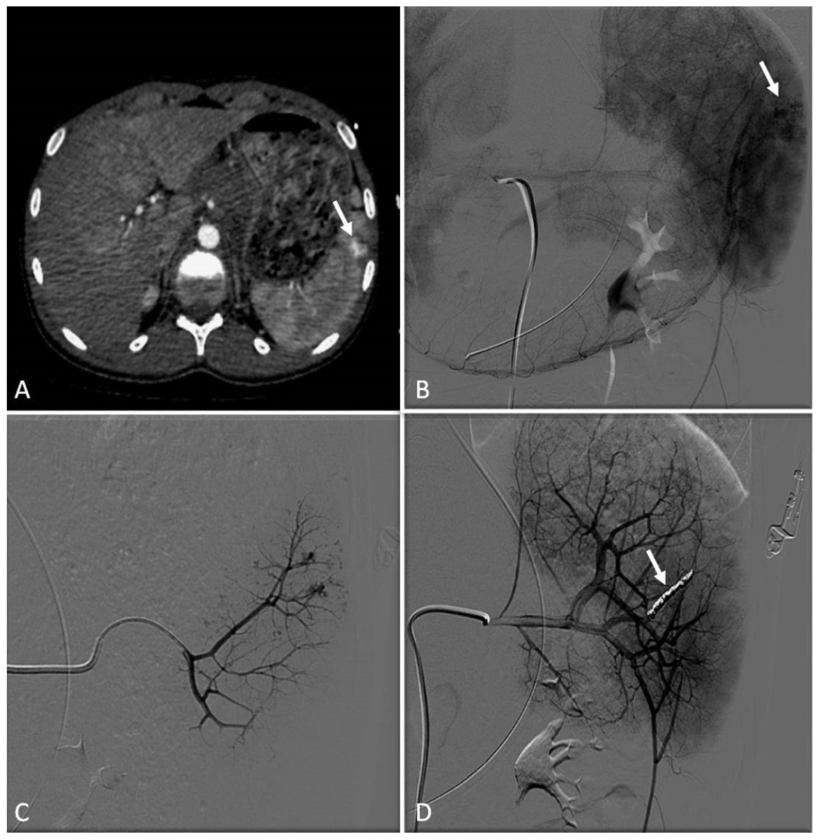 Blood clots: Pre-embolization 80 from 270 participants reported passing