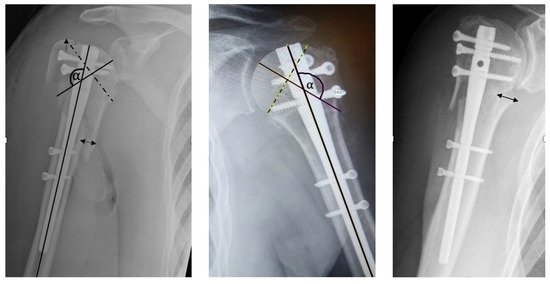 Figure 2 from Operative treatment of humeral shaft fractures. Comparison of  plating and intramedullary nailing. | Semantic Scholar