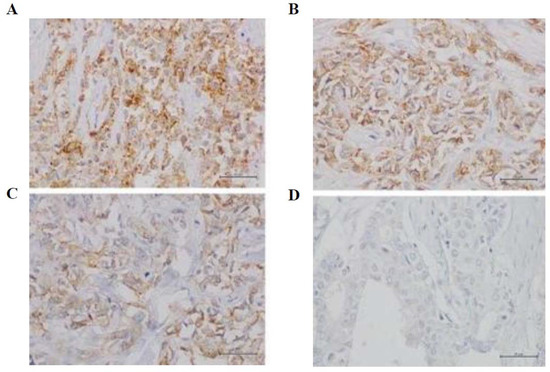 Expression of c-MET in Estrogen Receptor Positive and HER2 Negative ...
