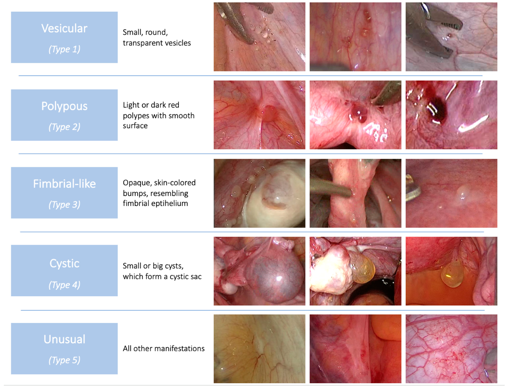 Second grade Slippery capitalism JCM | Free Full-Text | Intraoperative Appearance of Endosalpingiosis: A Single-Center Experience of Laparoscopic Findings and Systematic Review of Literature Second grade Slippery capitalism JCM | Free Full-Text | Intraoperative Appearance of Endosalpingiosis: A Single-Center Experience of Laparoscopic Findings and Systematic Review of Literature