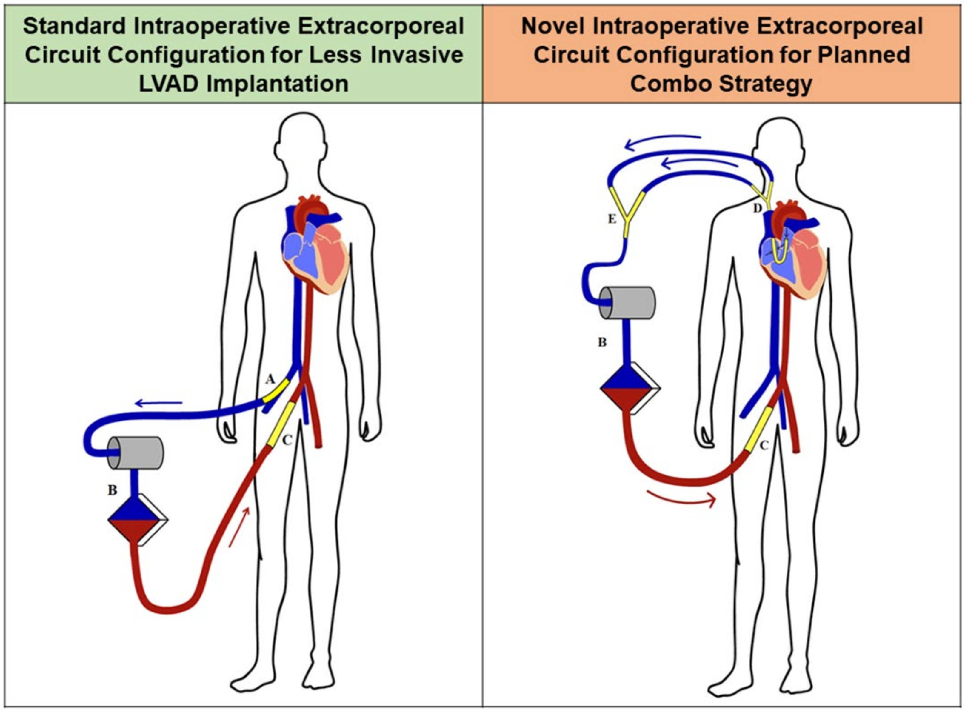JCM Free FullText Planned Combo Strategy for LVAD Implantation in