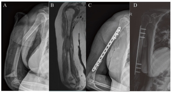 Long-Term Follow-Up of Biological Reconstruction with Free Fibular ...
