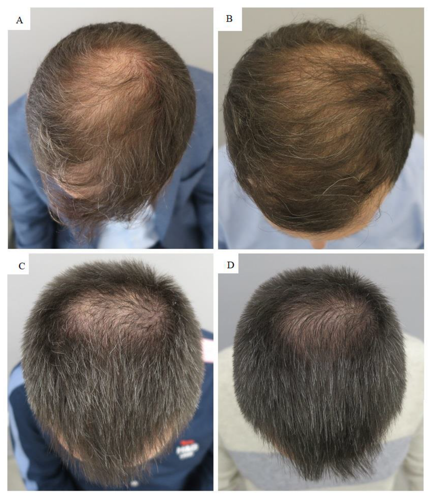 metallisk vride Piping JCM | Free Full-Text | Autologous Platelet-Rich Plasma (PRP) for Treating  Androgenetic Alopecia: A Novel Treatment Protocol Standardized on 2 Cases