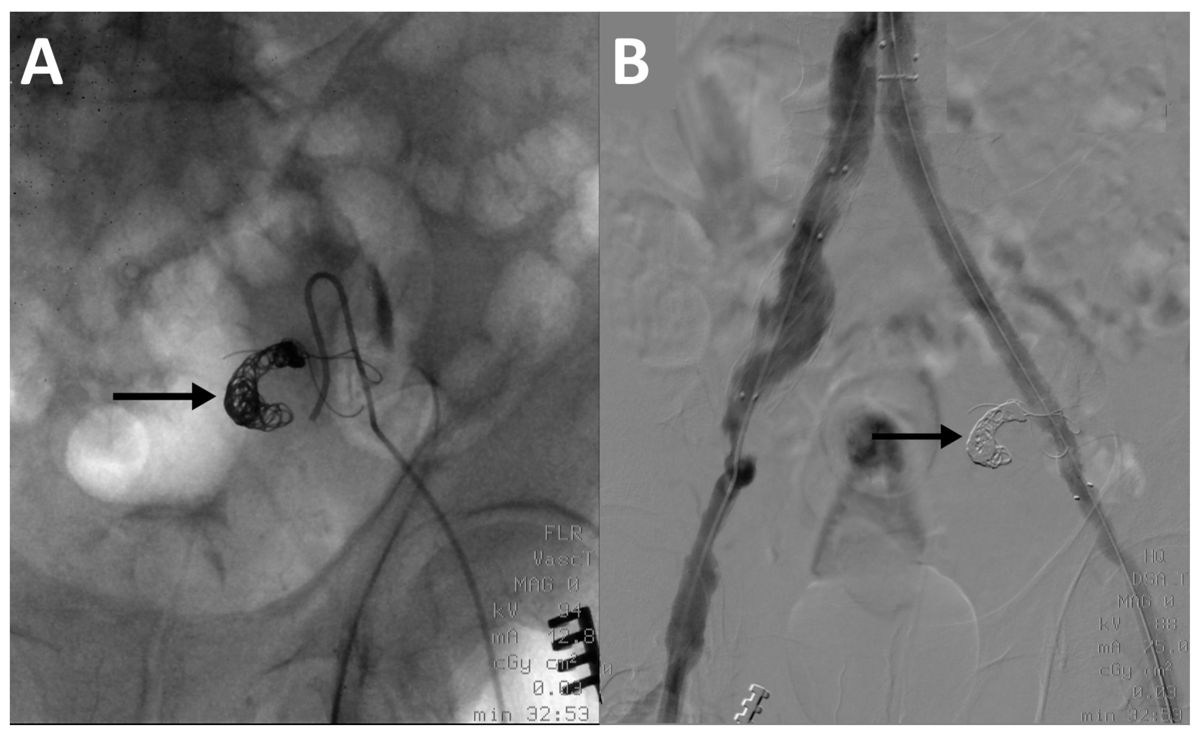 JCM Free FullText Internal Iliac Artery Embolization within EVAR
