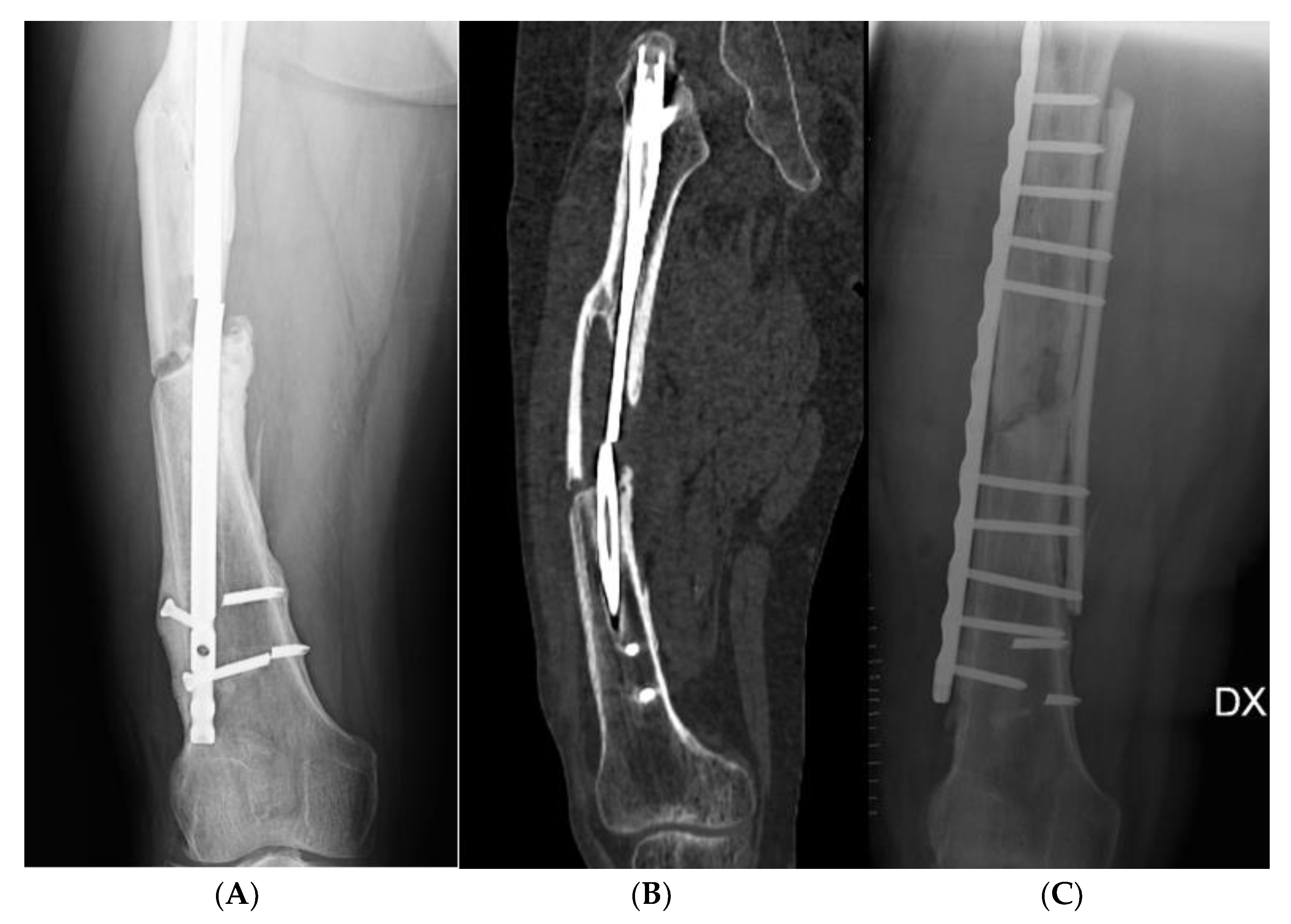 Does weight-bearing assignment after intramedullary nail placement alter  healing of tibial shaft fractures? - ScienceDirect