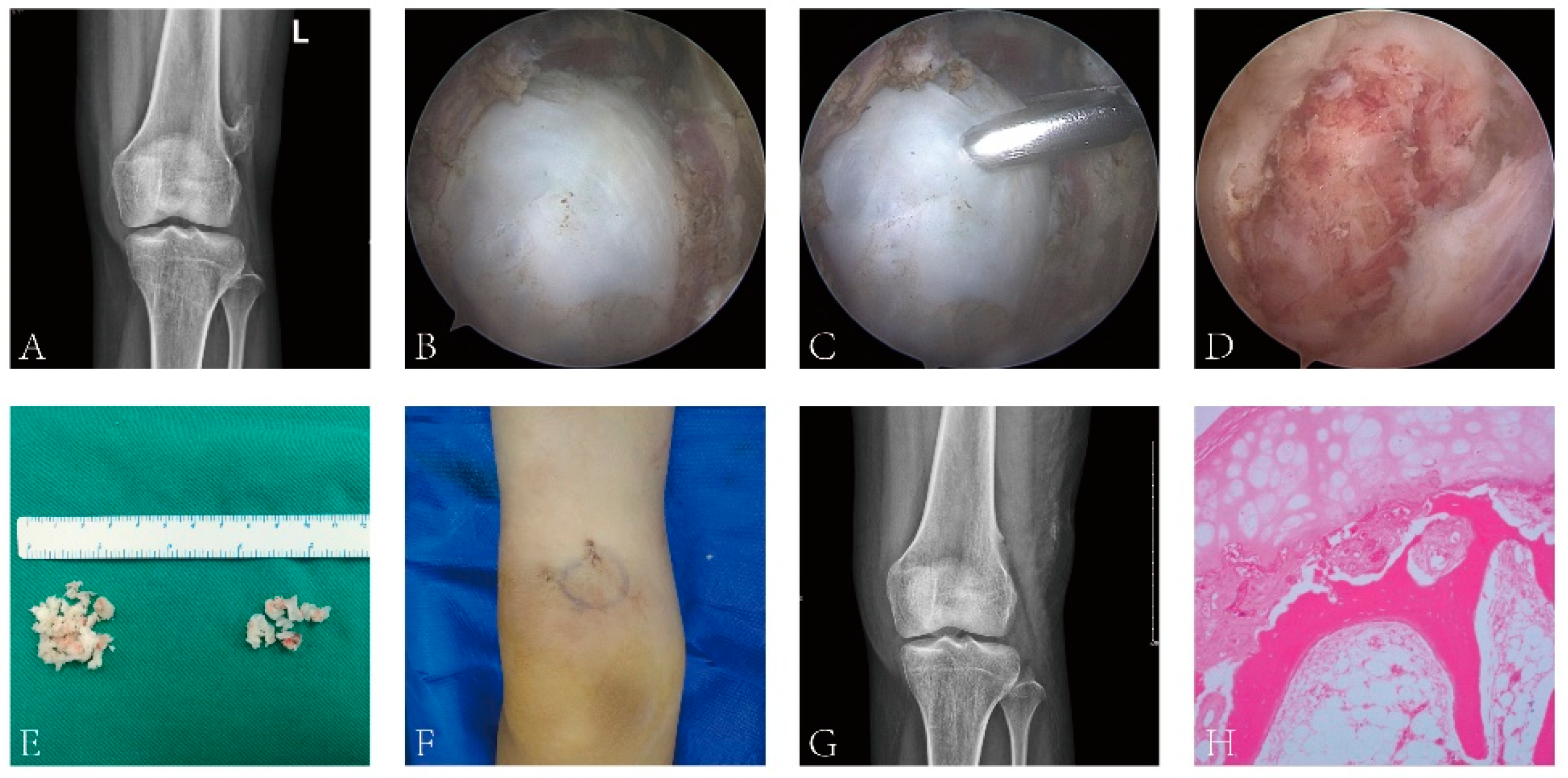 Tibial Pursuit: How to identify and side the tibia