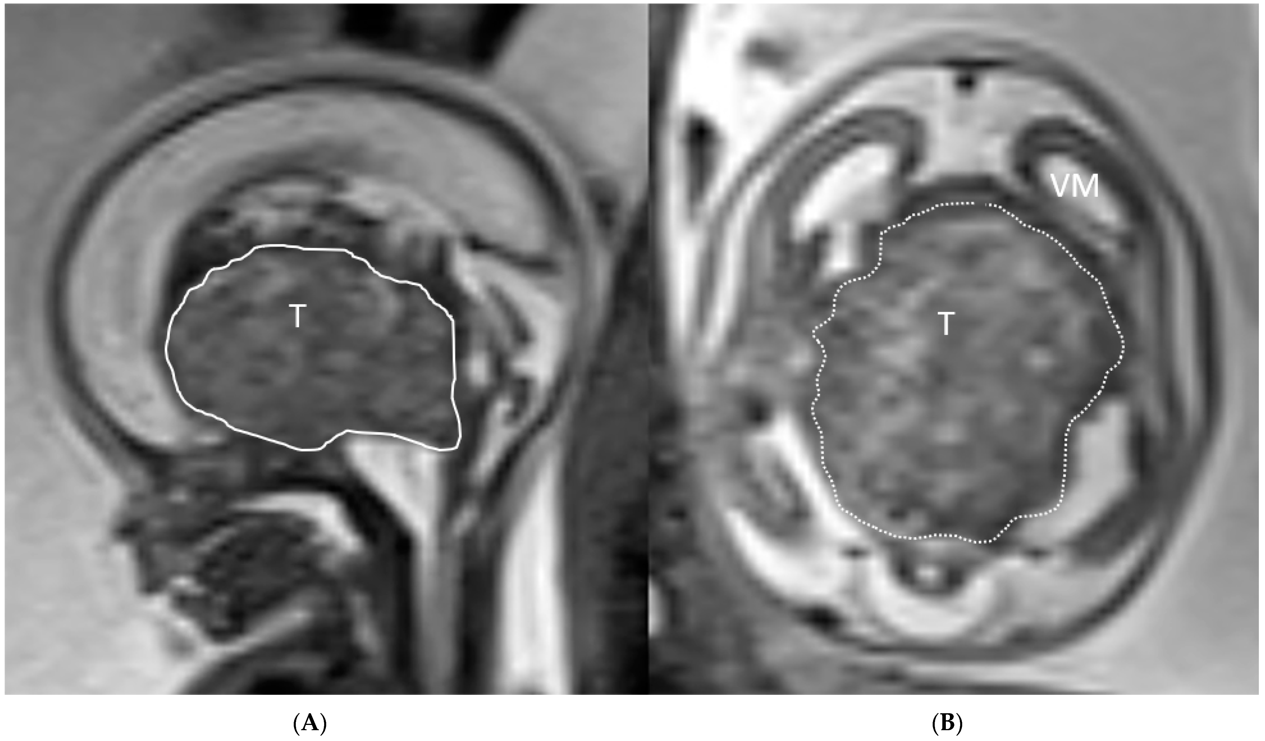 Use of MRI in the diagnosis of fetal brain abnormalities in utero  (MERIDIAN): a multicentre, prospective cohort study - The Lancet