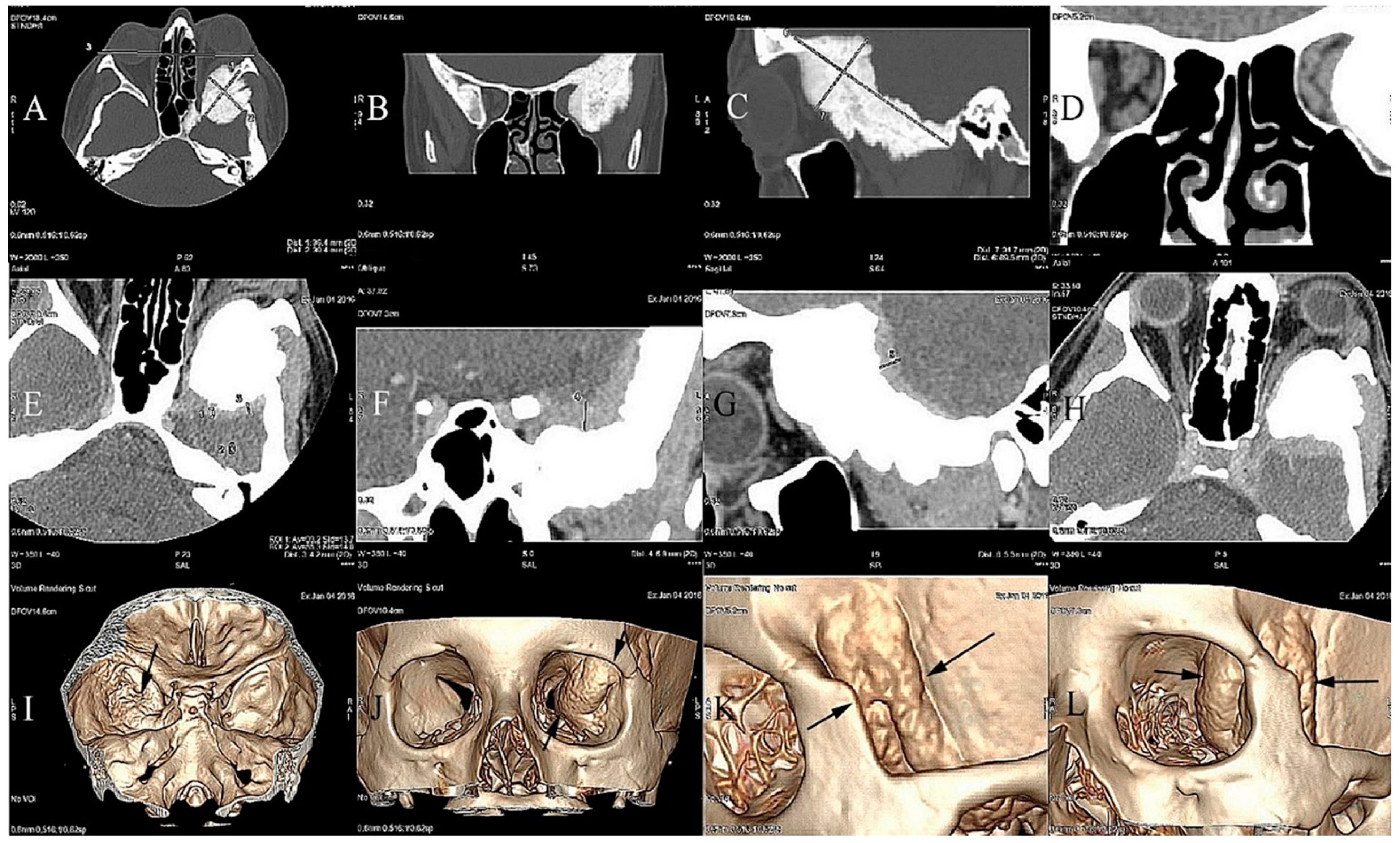 Spheno-Orbital Meningioma and Vision Impairment—Case Report
