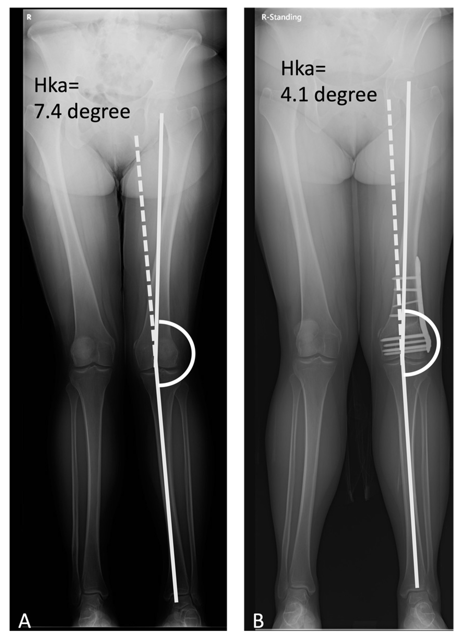 Functional and Radiographic Results of Arthroscopy-Assisted