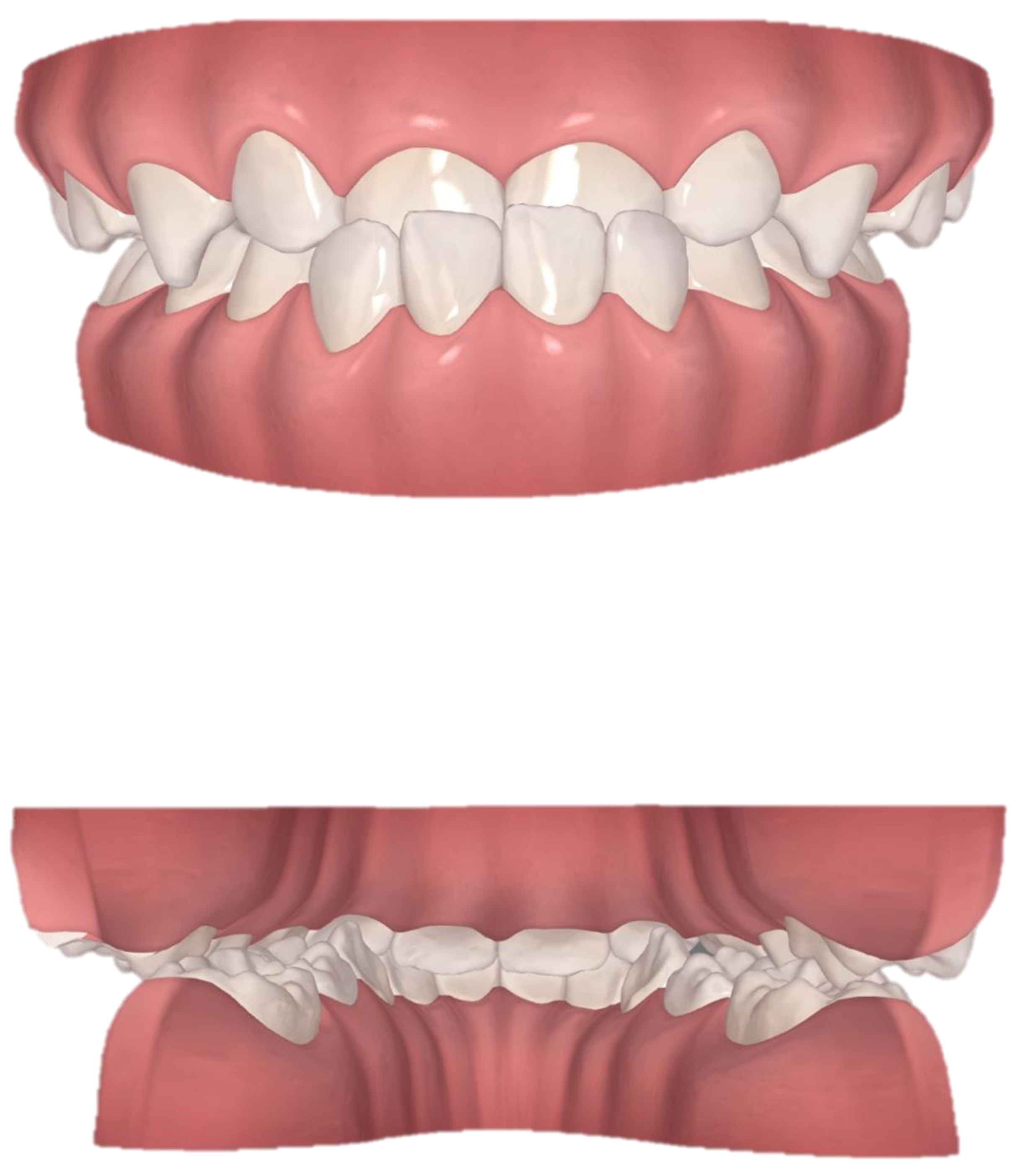 JCM Free FullText Invisalign Treatment of a ThreeYearOld Child