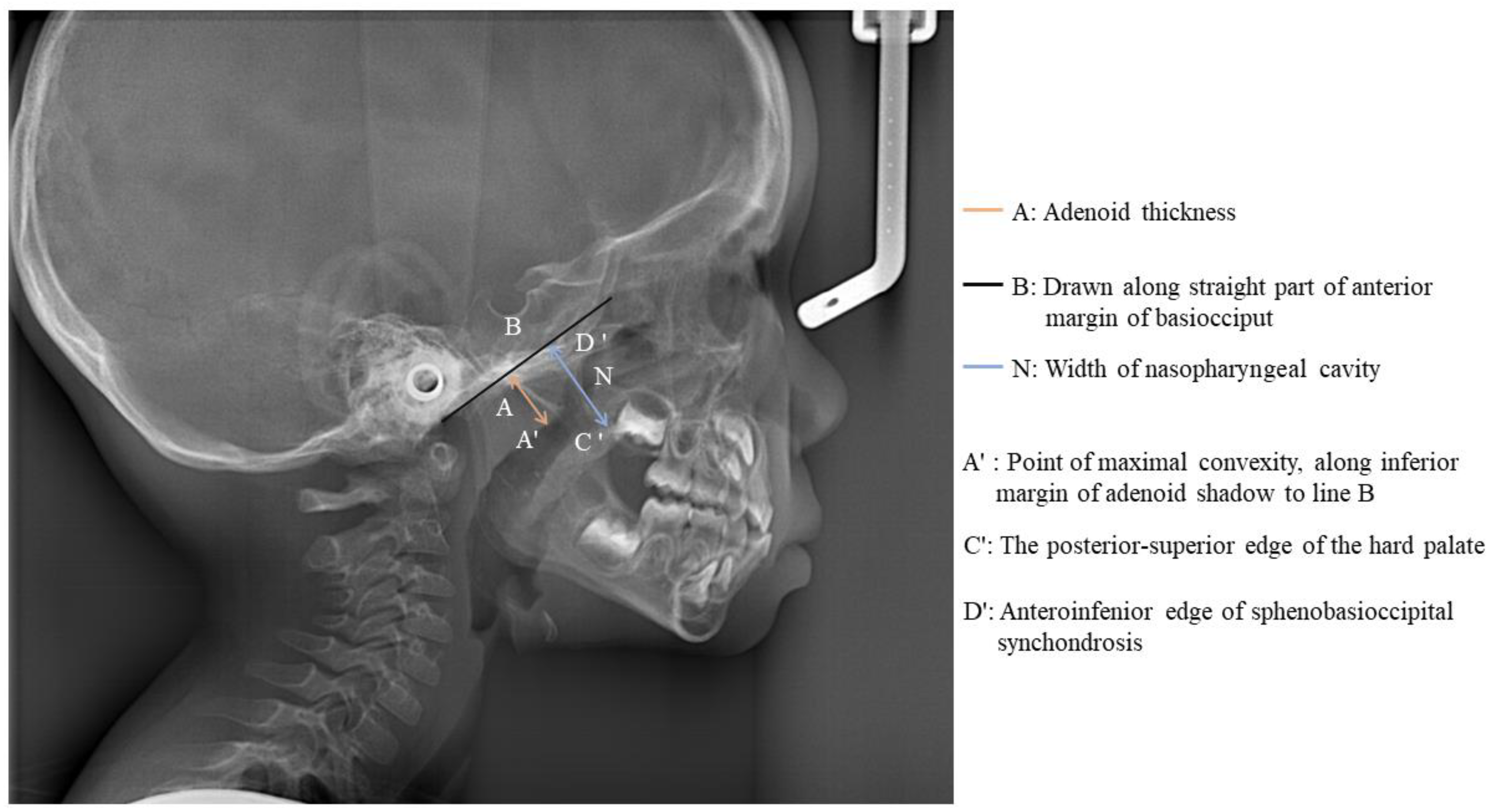 JCM Free FullText Invisalign Treatment of a ThreeYearOld Child with Bilateral Posterior