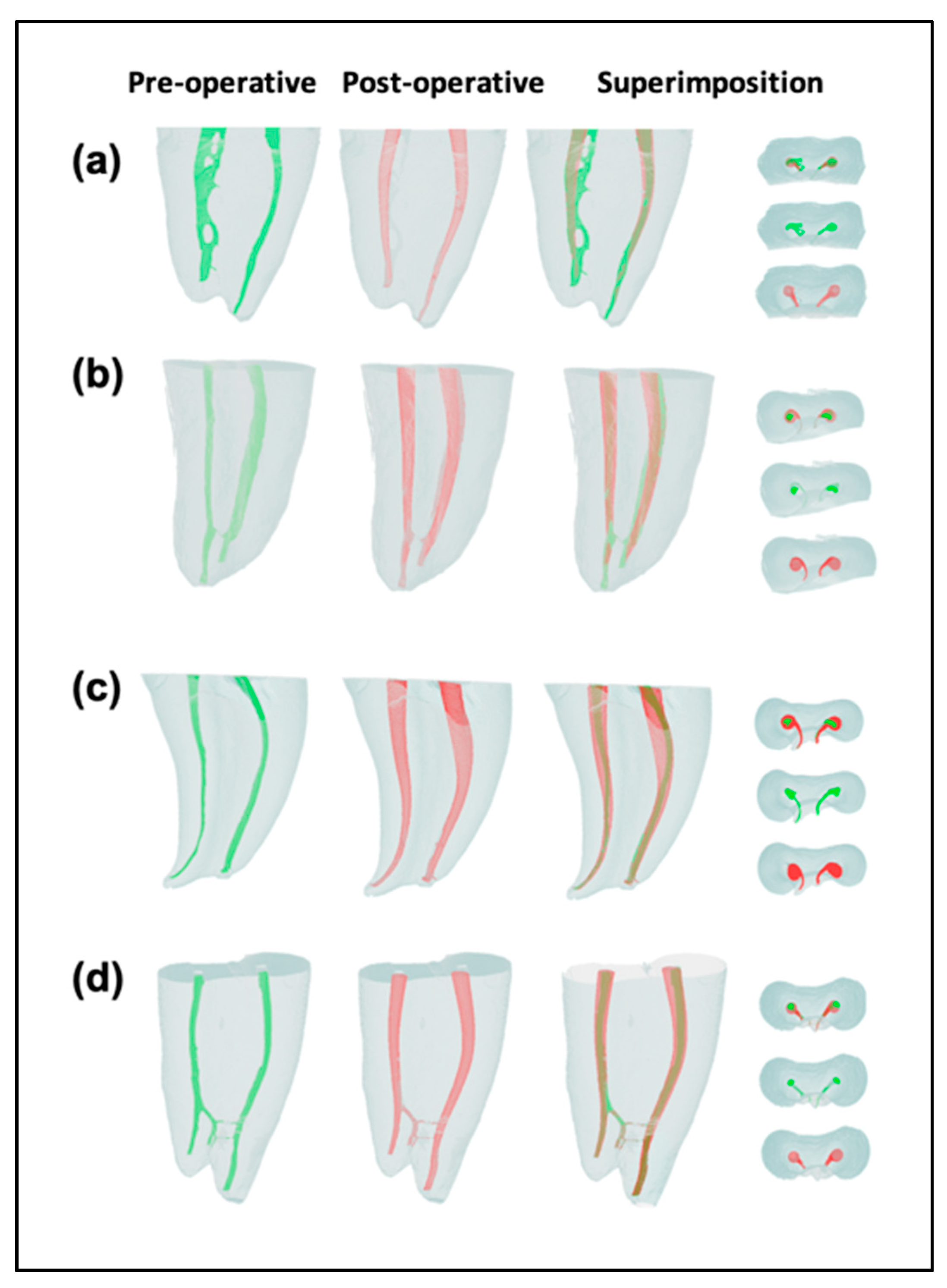 JCM Free FullText Influence of Coronal Flaring on the Shaping