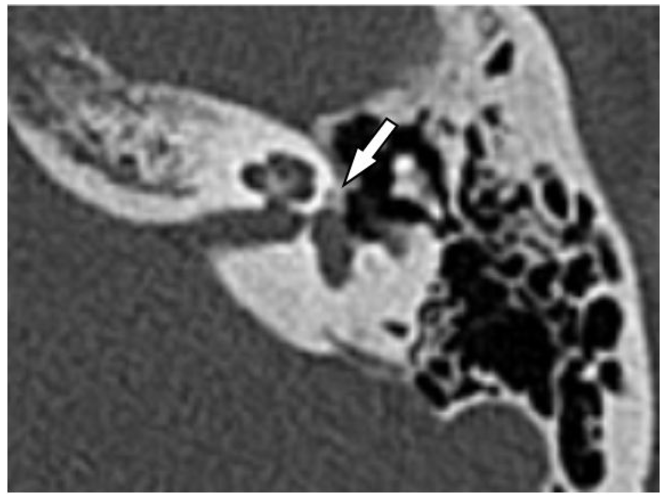 JCM Free FullText Missed Radiological Diagnosis of Otosclerosis in