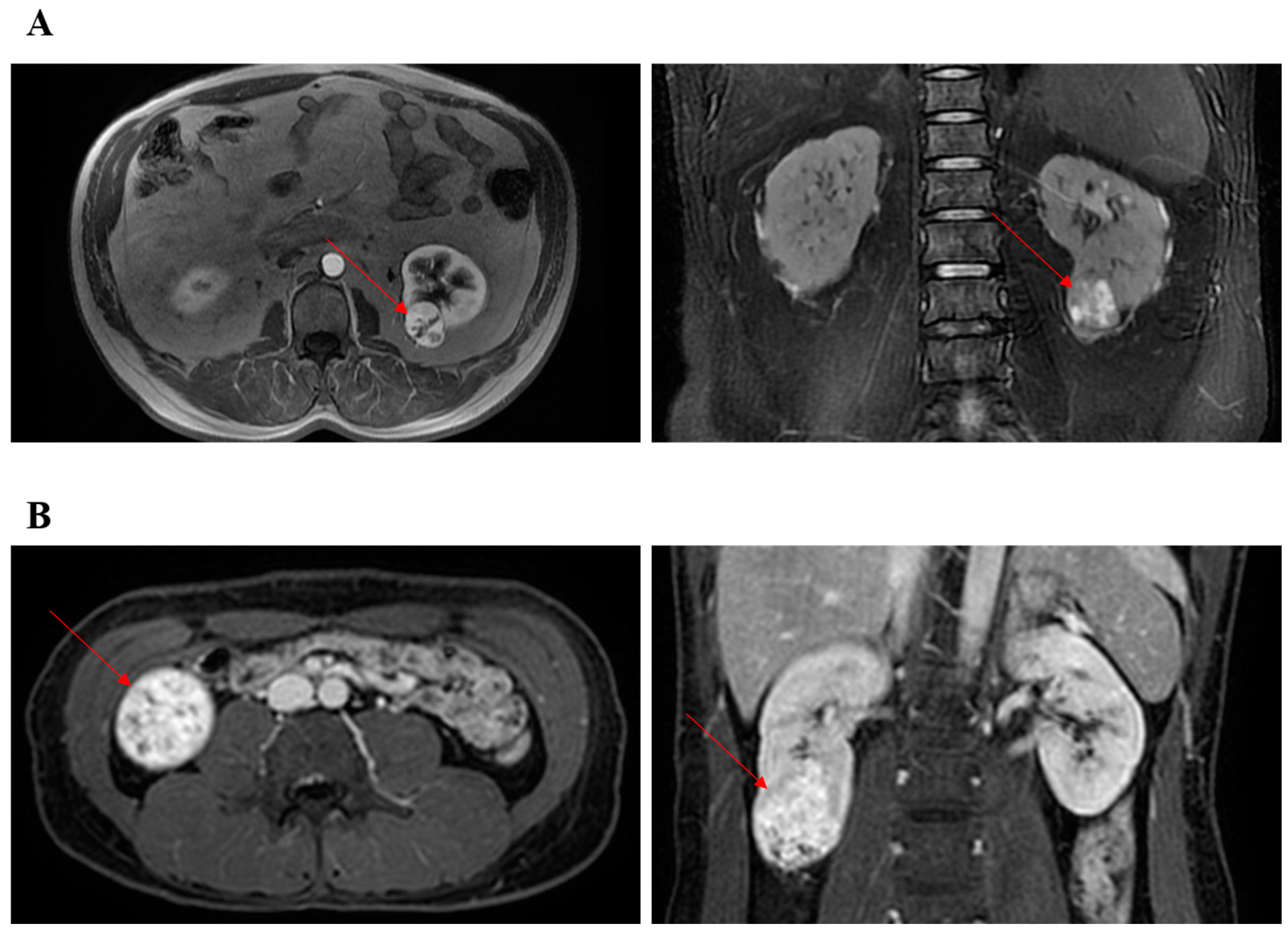 JCM Free FullText Comparison of Transperitoneal and