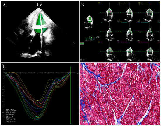 Viability Assessment With Global Left Ventricular Longitudinal Strain  Predicts Recovery of Left Ventricular Function After Acute Myocardial  Infarction