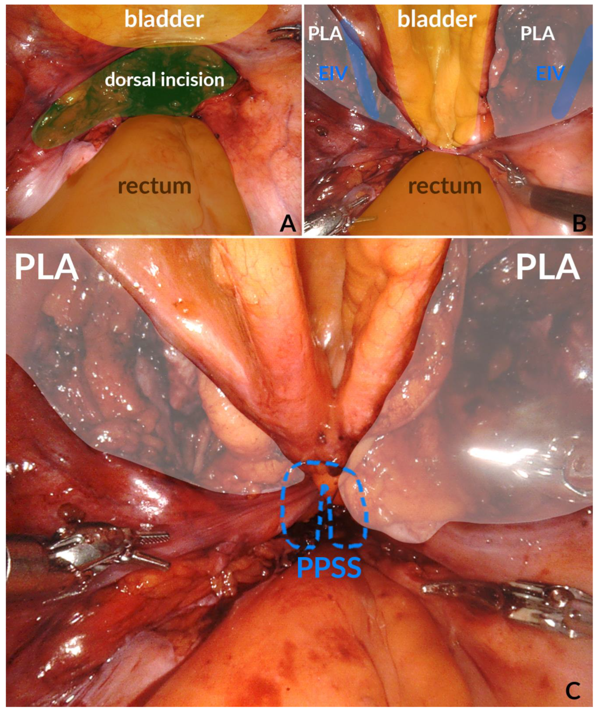 Laparoscopic Transabdominal Cerclage » Cervical Cerclage — A/Prof Alex Ades