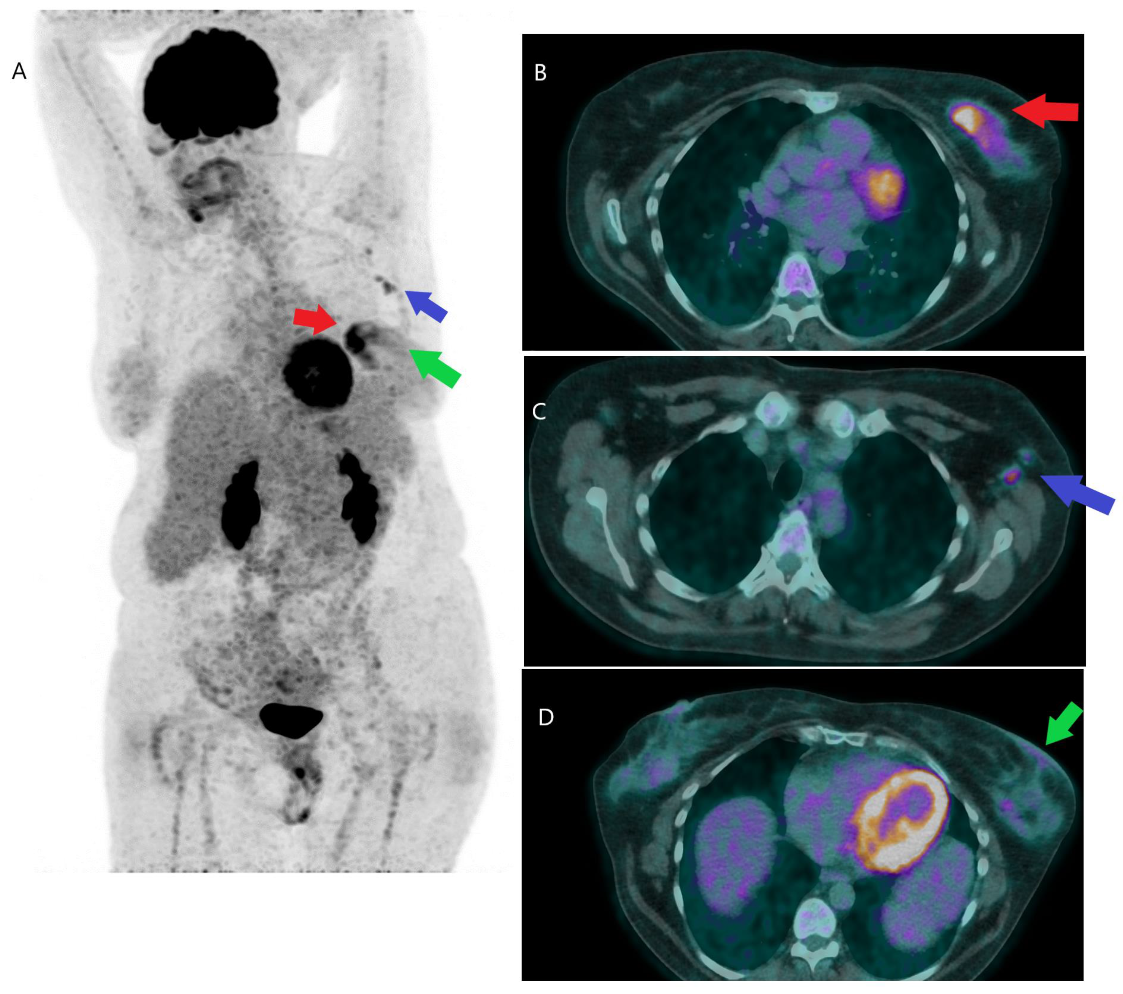 JCM | Free Full-Text | State of the Art in 2022 PET/CT in Breast Cancer: A  Review