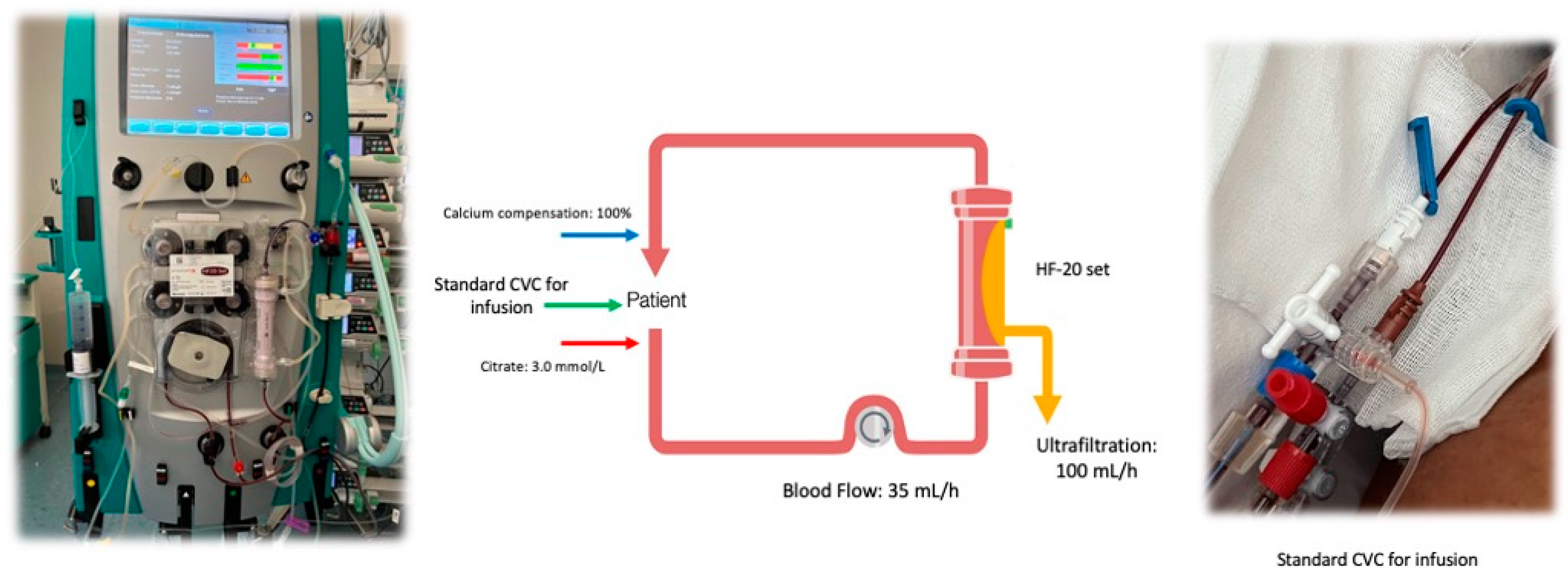 JCM Free FullText Slow Continuous Ultrafiltration in Regional